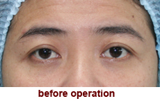 plastic-surgery-blepharoplasty